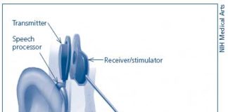 Diagram of a cochlear implant. Credit: National Institutes of Health